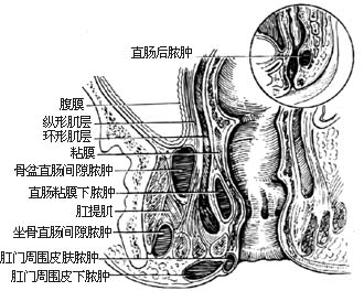 肛周脓肿科普图.jpg