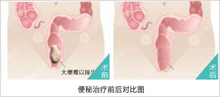 由于便秘引起的肛门疼痛是何原因？