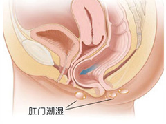 肛门潮湿的危害-福州总医院肛肠科