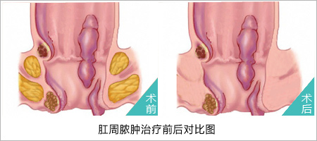 肛周脓肿怎么治疗医博医院值得信赖!