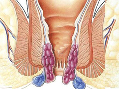 肛门外痔的症状有哪些？
