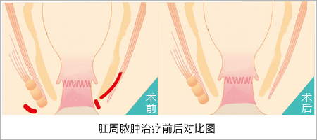 肛周脓肿怎么自己检查？