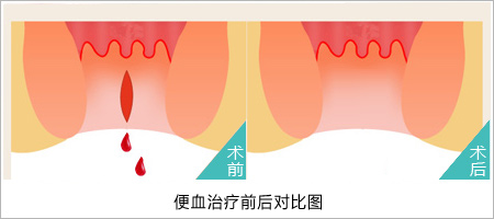 女性便血的判断！