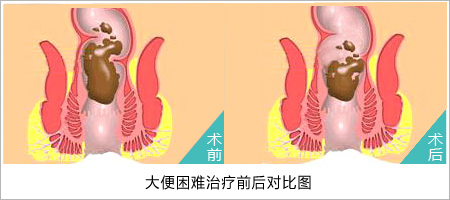 如何食疗便秘？