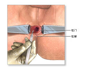 疼痛、便秘、出血-肛裂症状咨询！