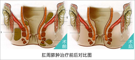 肛周脓肿医博肛肠医院!