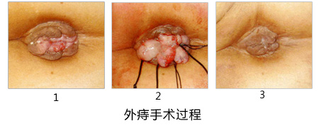 男性外痔有几种-外痔的分类？