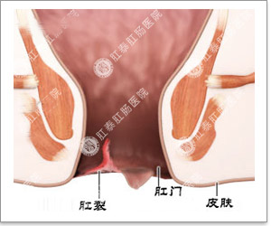 肛门疼痛是怎么回事？