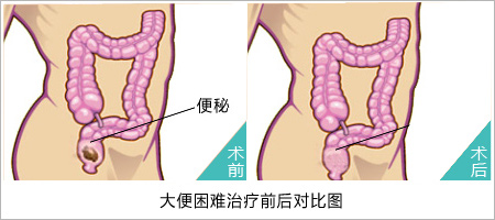 冬季发现大便困难如何处理！