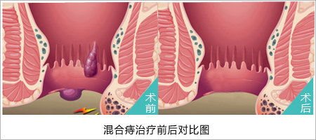 肛肠医院医博医院极受欢迎!