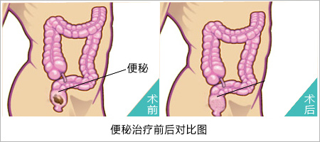 排便困难就是便秘了吗-福州肛肠专科医院