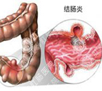 得结肠炎的原因有哪些？