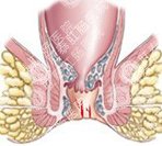 肛裂日常怎么预防？
