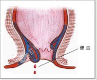 便血示意图