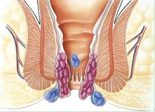 痔疮的治疗哪种方法极好