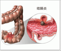 结肠炎的早期症状