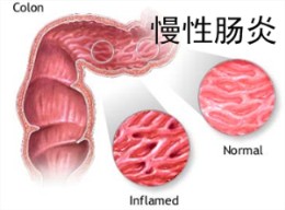 治疗慢性肠炎三大事项需谨慎