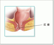 治疗肛瘘关键因素：正确找到内口