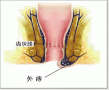 外痔疮手术费用