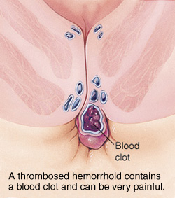 血栓性外痔出血怎么办