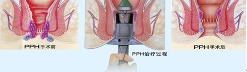 PPH肛泰方法治疗男性内痔疮三步走