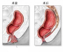 大便脱肛怎么办？