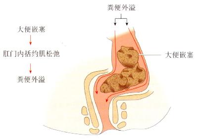 溃疡性结肠炎的治疗方法有哪些