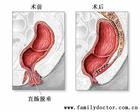 什么是直肠炎