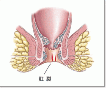 肛裂具体症状是什么？