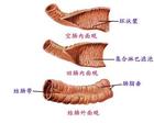 直肠炎不治疗有什么危害