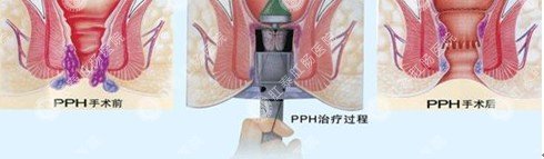 图示：PPH治疗内痔疮