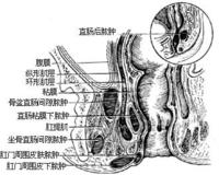 医生解析肛周脓肿病因