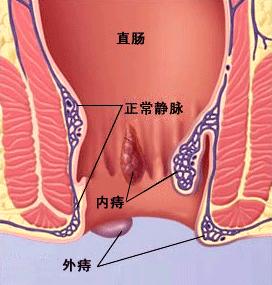 图示：女性外痔疮怎么治疗