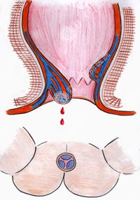 肛门出血可能是肿瘤？