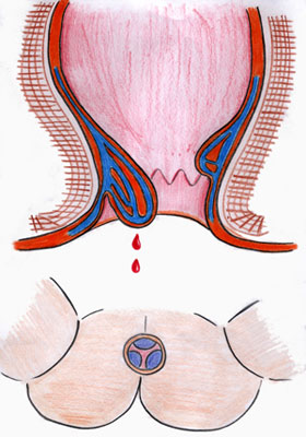 图示：内痔脱出有什么危害