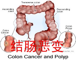 福州肛肠医院：结肠炎的危害