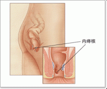 女性痔疮的危害