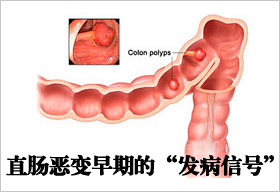 慢性直肠炎早期的症状？