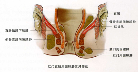 肛周脓肿会有什么症状