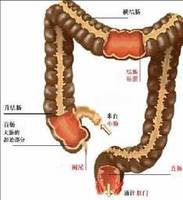 患上肛周脓肿会怎么样