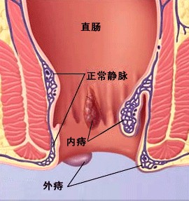 福州肛肠医院：如何检查出是痔疮？