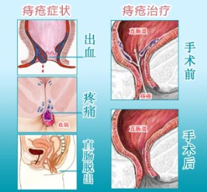 福州治疗痔疮多少钱？