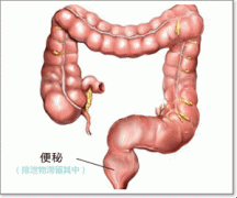 福州治疗便秘多少钱？