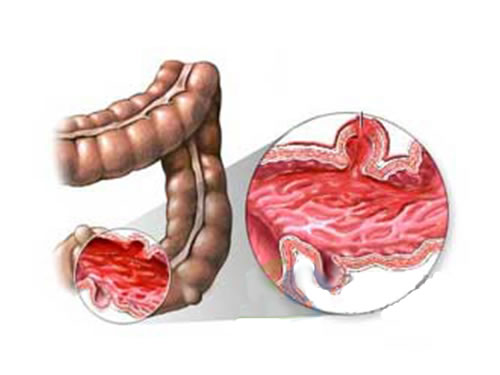 慢性肠炎的主要危害都有什么