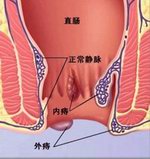 预防痔疮要从每做起！