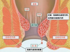 内痔为什么会找上你？