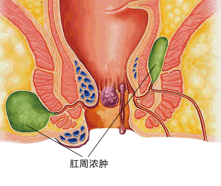 图示：肛周脓肿