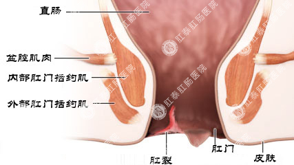 图示：肛裂