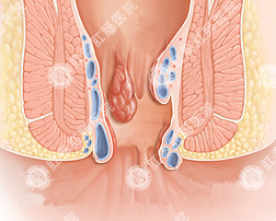 图示：内痔