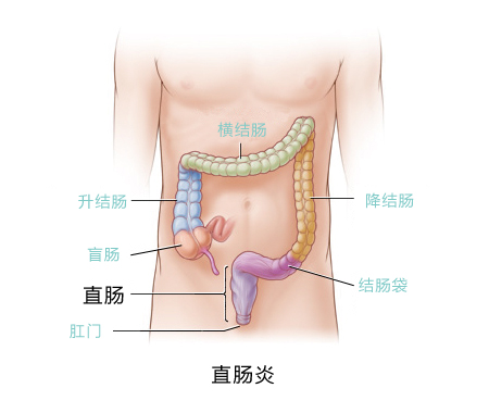 直肠炎由什么原因引起的